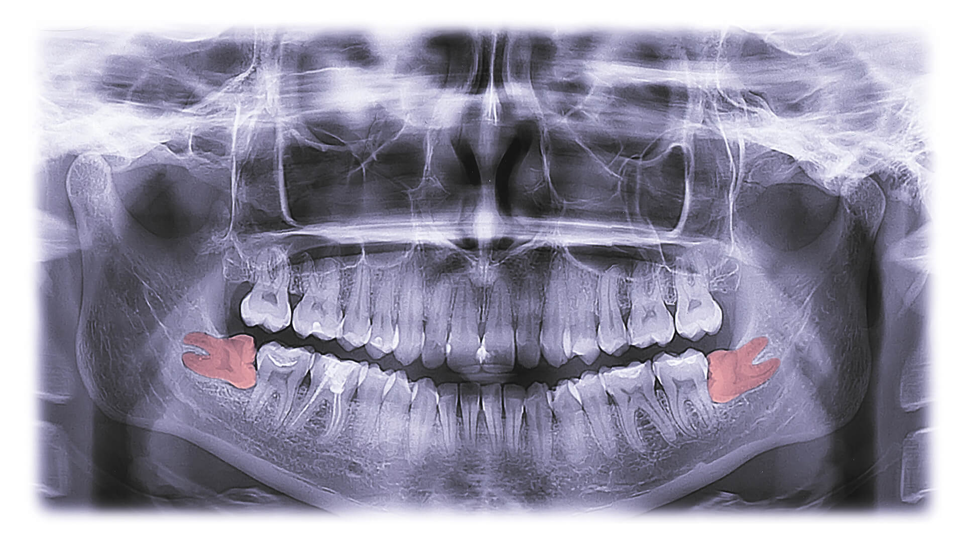 x-ray of molar teeth growing incorrectly