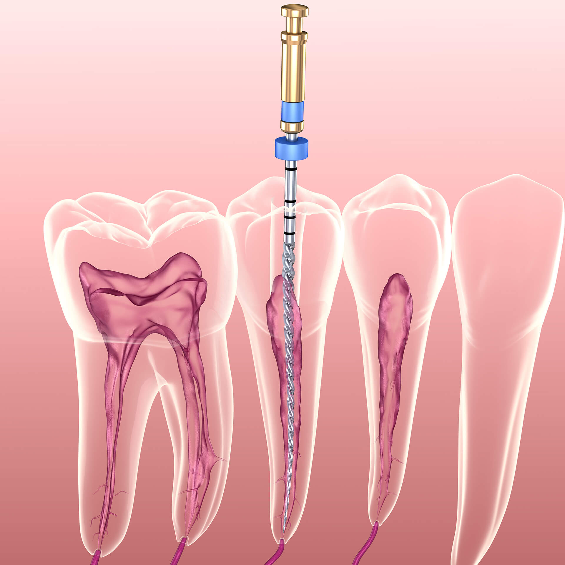 diagram of root canal procedure