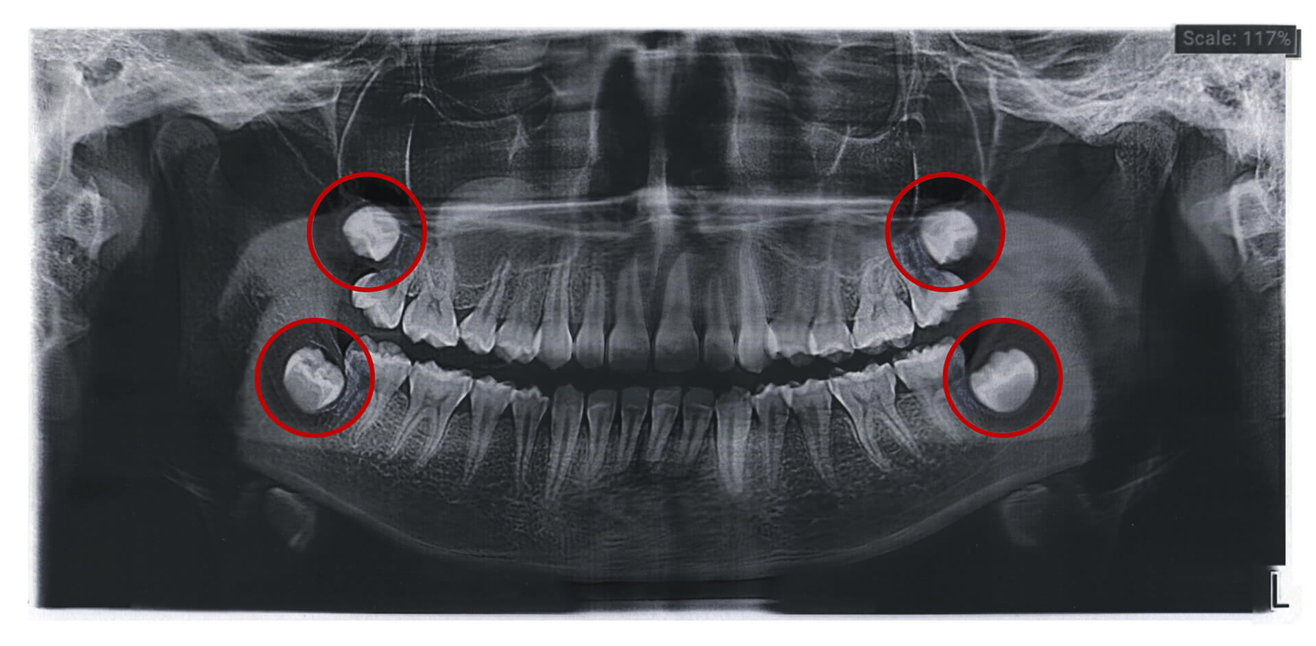 x-ray showing wisdom teeth