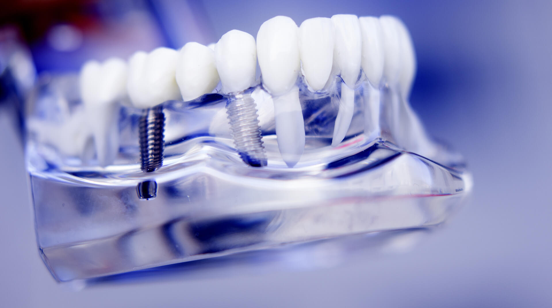 teeth model showing dental implants