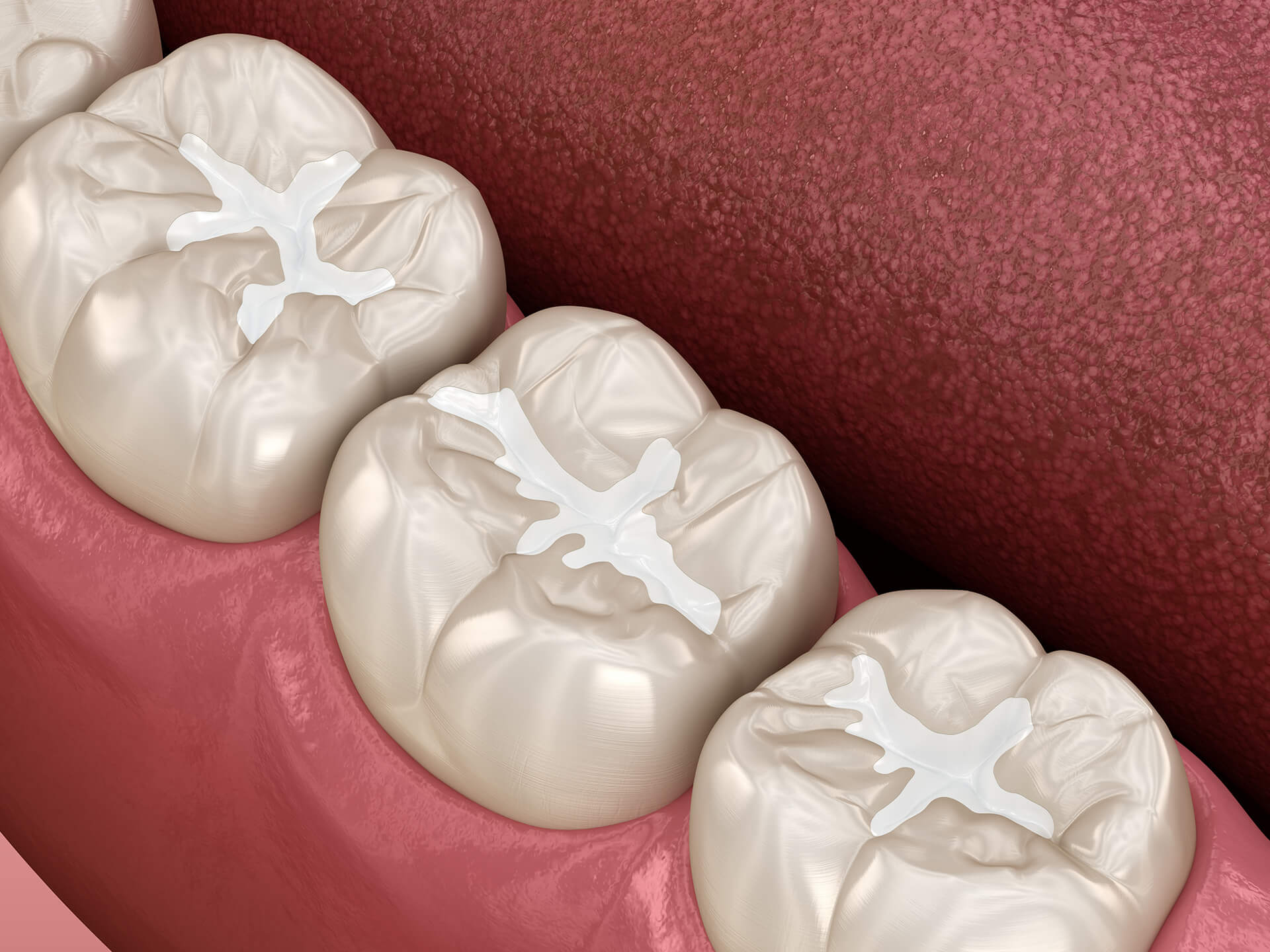 image of fillings on teeth