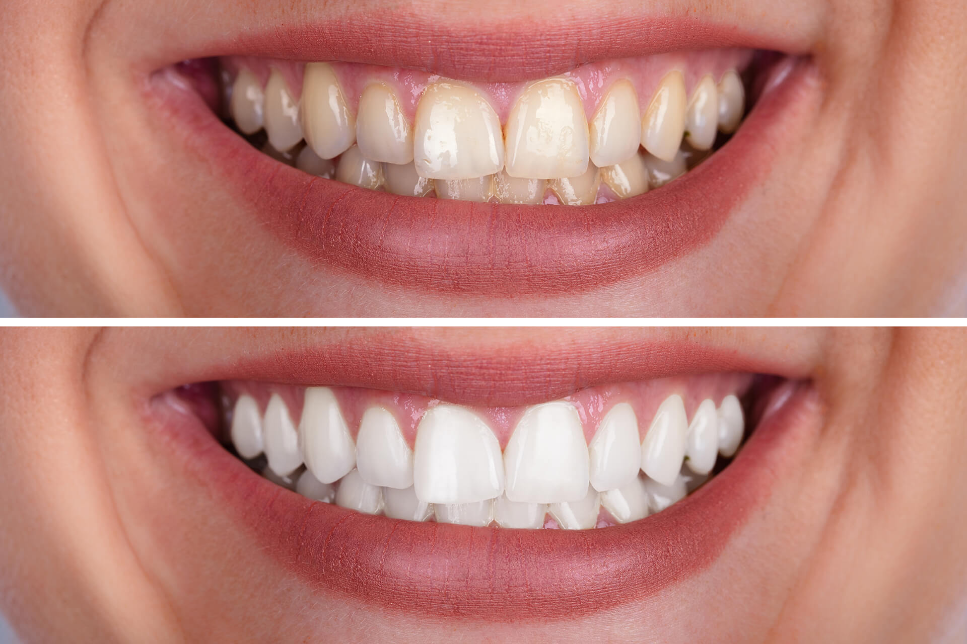 before and after teeth color